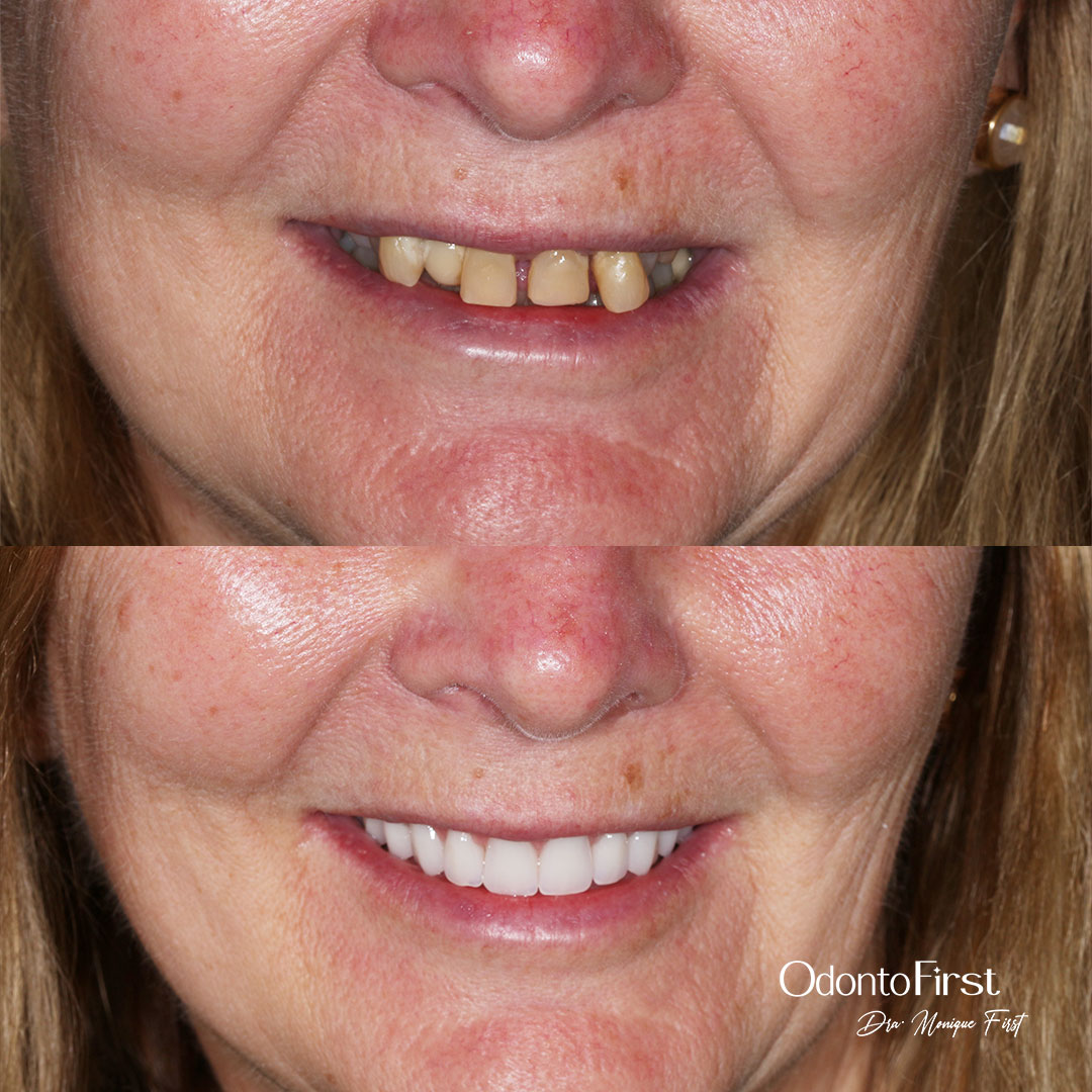 Imagem de antes e depois sobre o resultado de tratamentos dentários